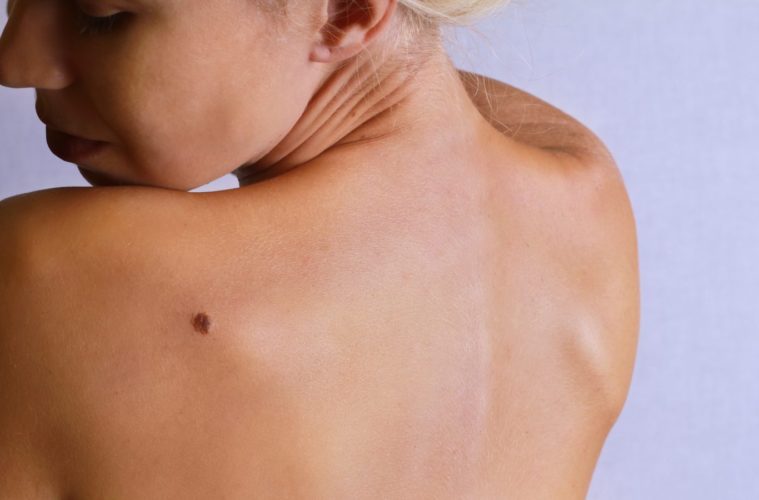 Top 10 Risk Factors Of Melanoma And How To Prevent It 38 Cancer