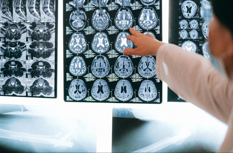 Losing Inhibition After Brain Trauma — What You Need To Know 38 Losing Inhibition After Brain Trauma e1615219770687