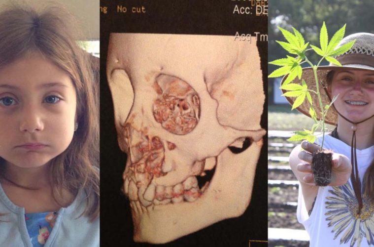 The Face of Cannabis: Treating a Disfiguring Bone Disease 38 Riley