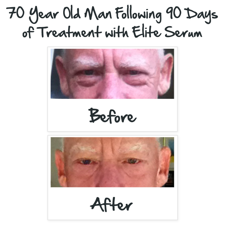 elite serum before and after