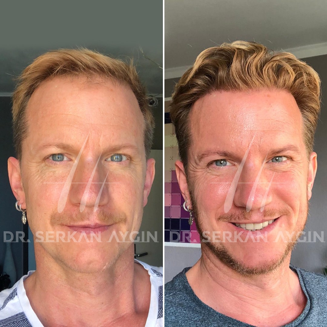 Hair transplant cost Turkey before after