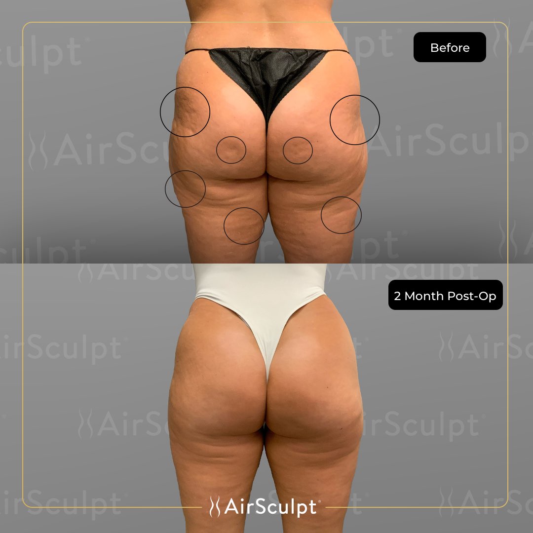 AirSculpt® Away Stubborn Fat in Time For the New Year - LA Weekly