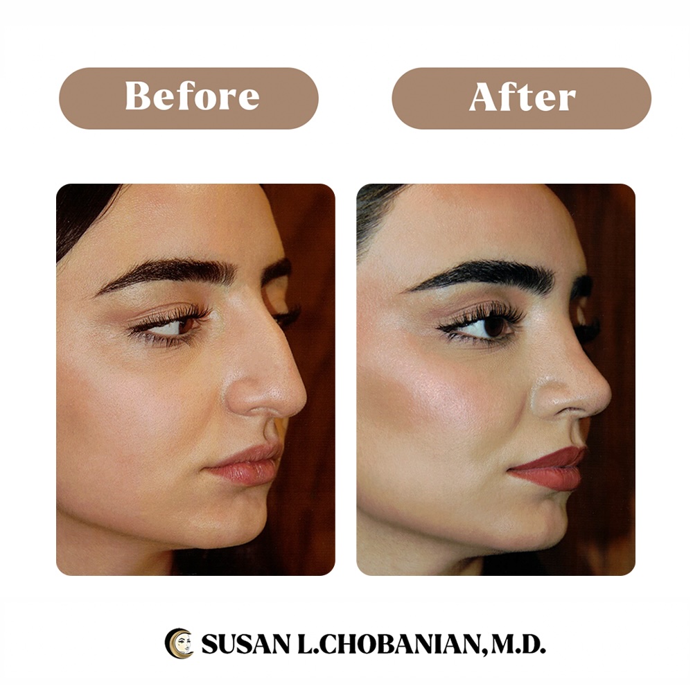 Facial Rejuvenation for Every Age: When to Start Your Journey 39 image3 Chobanian